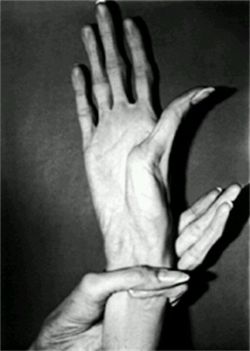 sixpenceee:  Marfan syndrome is a disorder of connective tissue,