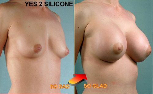 faketitslover999:  boobinfo:   YES 2 SILICONE. SCIENCE!   Silikon macht Frauen schöner!  Always say yes to implants.