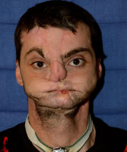 sixpenceee:  Disfigured after a shotgun accident blew off half