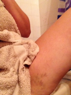2wet4u:  sex bruise from Saturday