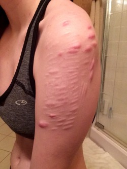 Here’s my scars for the person who asked