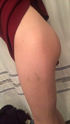 foxykinkyprincess:  Bruises from my lover, possibly from a bite