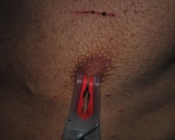 gymboas:This is what is left of my nipple after being clamped