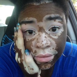 laninjapanama:  I’m sleepy. #GoodMorning #vitiligostandup #vitiligo