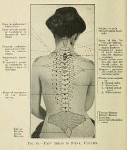 nemfrog:  Fig. 78. Pain areas in spinal column. Pain, its origin,