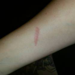 Went to open the gates of hell (the wood stove) and got branded,