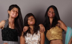 Victims Of ‘Acid Attacks’ Join Together For A Fashion Shoot