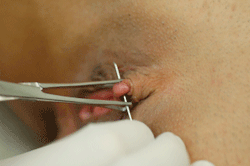 tattedupandpierced:  Doesnt piercing the actualclit damage the nerves? Arent VCH safer and more pleasurable?