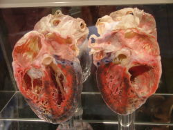  Old heart of a transplant patient 