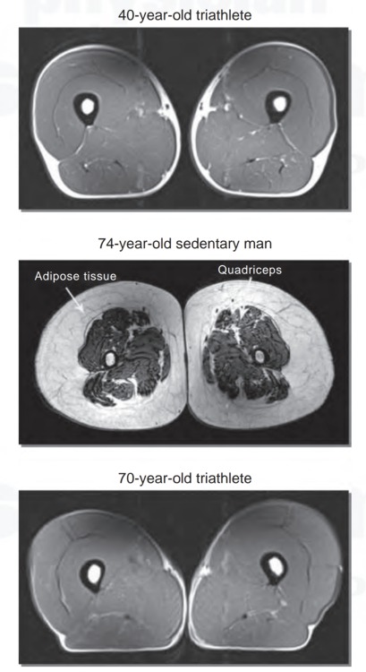 sixpenceee:   MRI  cross sections of upper legs, showing the