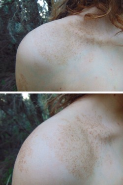 soulescaper:So, I have this friend and she has this kind of birthmark