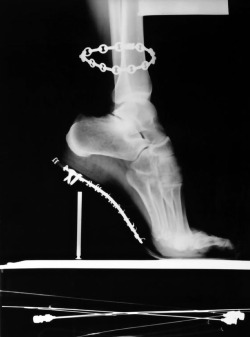 Helmut Newton - X-Ray of High Heeled Shoe and Cartier Bracelet,