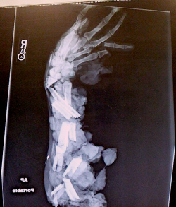 roubidox:  X-ray of a meat grinder injury to the arm and hand