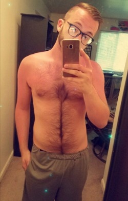 wolfysuxx:I got a sunburn (and a haircut) today. ☀