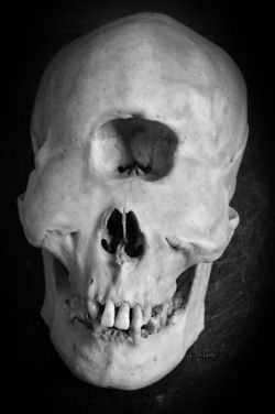 dollysobsessionwithskulls:  Cyclopia (also cyclocephaly or synophthalmia)