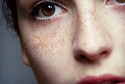 cheesies:  grlvity:  ‘I had so many freckles that my mum used