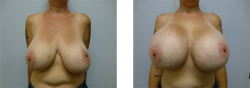One of the most popular methods of real life breast expansion