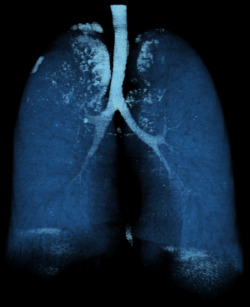 medicalschool:  Lungs Volume Rendering of an ECG gated I.V. contrast