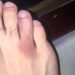 Busted my toe two days ago at 3am walking back from the bathroom