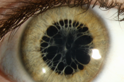 agabella:  Persistent pupillary membrane photo by Cindy Montague