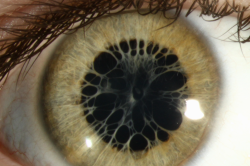 logija:  Persistent pupillary membrane photo by Cindy Montague