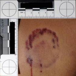 iliveinacementery:  The bite-mark that convicted Ted Bundy. 