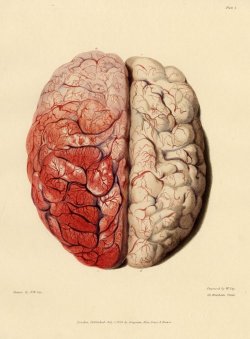 corporisfabrica:  Severe Inflammation of one cerebral hemisphere.From 33