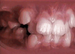 educational-gifs:  How braces align teeth over time.