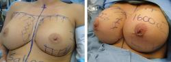 Breast Enhancement Surgery is the fastest way to grow your breasts