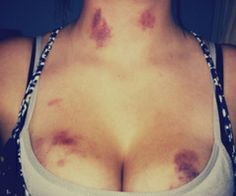 daddys-lil-cum-slut:  odaxelagnia arousal from being bitten or