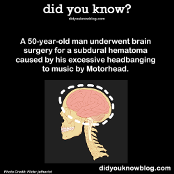 did-you-kno:  A 50 year old man underwent brain surgery for a