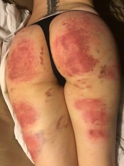 camdamage:  Marks from last night (pics from last night too)