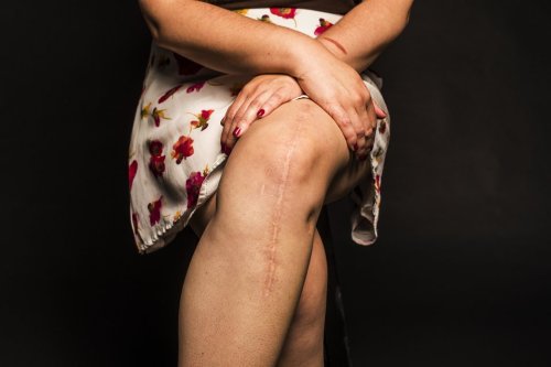 huffingtonpost:  24 Women Bare Their Scars To Reveal The Beauty In Imperfections“It’s a reminder that we can heal no matter what happens to us.”Photos by: Damon Dahlen 
