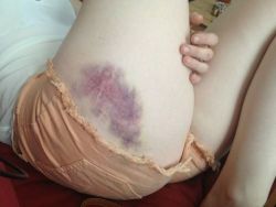 bruisedandyours:  bruise me daddy