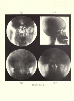 nemfrog:  Plate 2. An x-ray atlas of the skull. 1918.