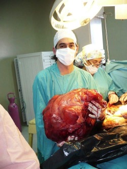 A 54 year old woman was surgically intervened at Hospital Gandulfo