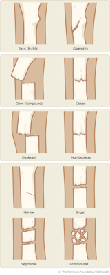 phiairmed:  Different kind of fractures 