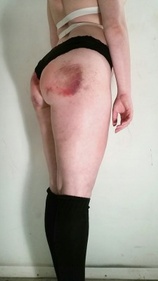 princesssparklecunt:  I asked Mister to give me bruises on top