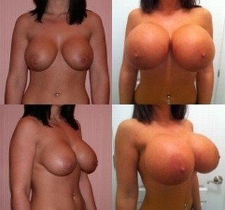 siliconeandmore:  that’s a really nice augmentation I love before-and-after-pics  She just inflated those things into awkwardly huge blimp tits. I love it!!!!