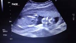 sixpenceee: The ultrasound belonging to reddit userÂ justme_countrynerdÂ 