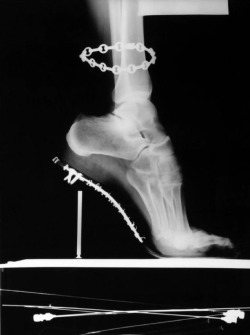 saintlaurentgirl:   X-Ray of High Heeled Shoe and Cartier Bracelet