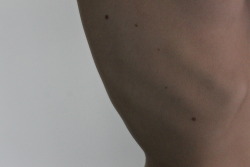 vizio-assurdo:  my birthmarks 