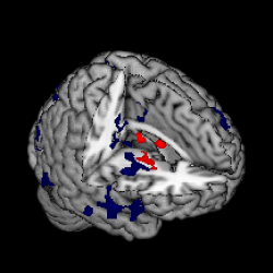 neurosciencestuff:  Neurological underpinnings of schizophrenia