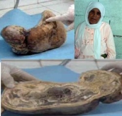 Zahra Aboutalib, Morocco, carried her child in her womb for almost