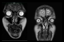 sixpenceee:  MRI scan of a human head 