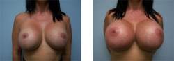 She remembers the day she got her first set of implants - 1000cc