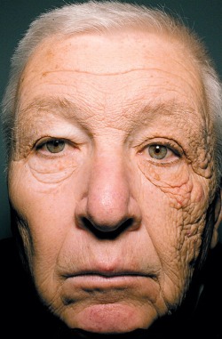 emt-monster:  Sun induced ageing This gentleman is 69 years old,