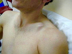 emt-monster:  Broken collarbone / clavicle fracture  Source: