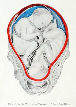 biomedicalephemera:  Types of Twins Twins are more complex than