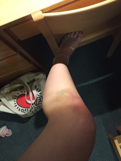 Frat bruise + light prism ✨